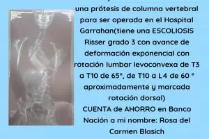 Malena, una nia de 11 aos, necesita una prtesis de columna vertebral con urgencia