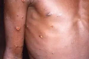 Viruela del mono: la OMS asegura que el brote puede controlarse y el riesgo de transmisi�n es bajo