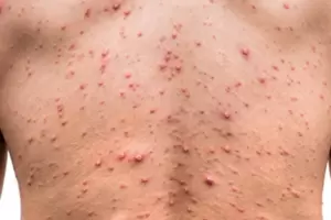 Reino Unido detect una nueva variante gentica de la viruela del mono