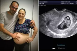 Buscaban su primer hijo y qued embarazada de trigemelas: un caso excepcional