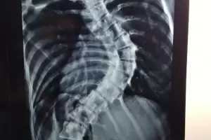 Exitosa ciruga de columna en el Hospital San Juan Bautista