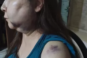 Fue a cobrar una deuda a su vecina, el nieto la atac y le desfigur el rostro