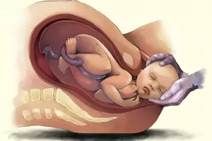 Qu es la distocia de hombros, lo que caus la muerte del beb en la Maternidad