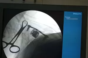 Profesionales del San Juan realizaron en Catamarca la primera corpectoma