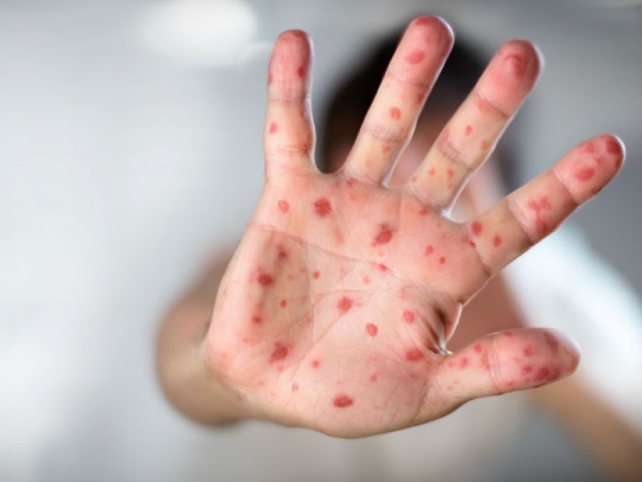 Sarampión: dos personas de Catamarca permanecen bajo vigilancia epidemiológica · Examedia
