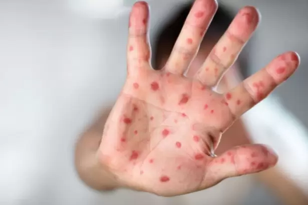 Sarampi�n: dos personas de Catamarca permanecen bajo vigilancia epidemiol�gica