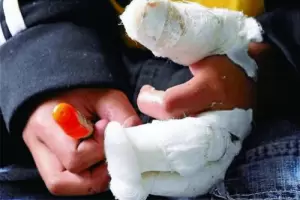 Usando pirotecnia un nio perdi un dedo y otros cuatro tienen quemaduras