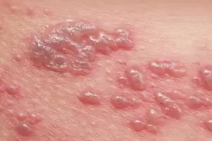 Reportan nuevo sntoma de la cepa micron