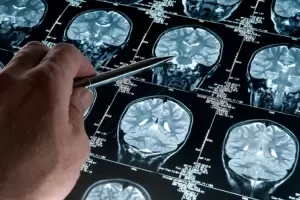 Un software de desarrollo argentino podra diagnosticar de forma precoz el Alzheimer