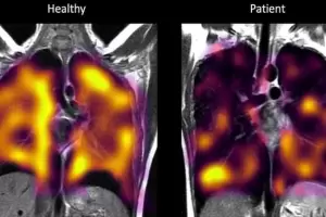Pacientes pos Covid podran experimentar daos en los pulmones, indetectables por las tomografas