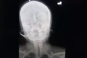 Una mujer embarazada de una nia, fue a un curandero que le hundi un clavo en la cabeza para que d a luz a un varn