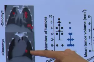 Omomyc, el nuevo frmaco que le da esperanzas a pacientes con cncer de mama