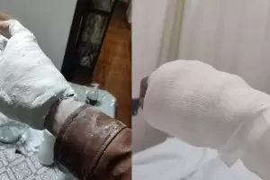 Choc� con la moto, lo enyesaron con la campera puesta y ya no pudo sac�rsela