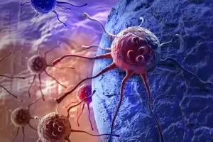 Un prometedor estudio clnico seala que remiti el cncer de colon en 18 pacientes