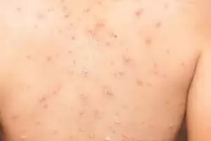 Confirmaron el sptimo caso de Viruela Smica en Argentina