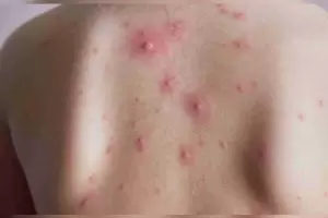 Viruela del mono: La OMS declar el fin de la emergencia sanitaria internacional