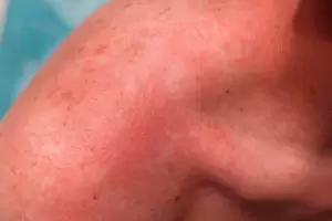 Confirmaron un nuevo caso de viruela del mono en C�rdoba