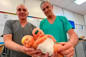 Con una exitosa ciruga, separaron a siamesas unidas por el hgado e intestino