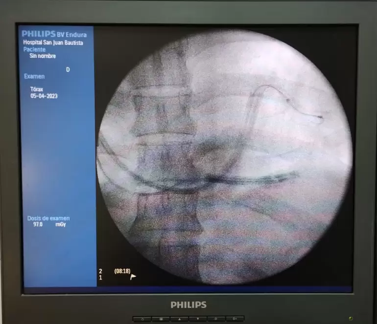 cirugia cardiaca hsjb
