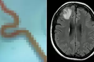 Una mujer fue operada del cerebro: los cirujanos encontraron algo que no esperaban