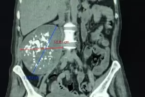 Mdicos del "San Juan Bautista" extirparon un tumor gigante de una paciente