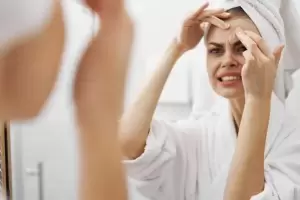 Problemas con el acn?, especialista te cuenta cmo combatirlo