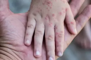 Salud adelanta la segunda dosis contra el sarampin: Cundo ser?