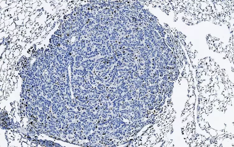 Vista microscpica del cncer de pulmn (IRB)