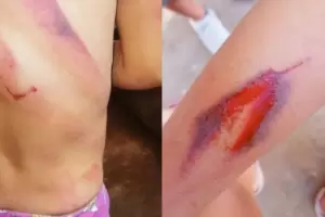 El padrastro que golpe a una nia de 4 aos seguir detenido