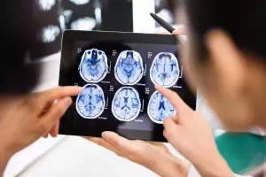 Avanza vacuna personalizada contra el tumor cerebral ms letal: resultados prometedores