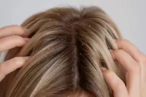 El poderoso truco casero para eliminar la caspa por completo