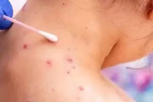 Viruela del mono: Ya son 65 casos confirmados en Argentina