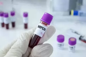 Alerta global por la viruela del mono: 6 preguntas clave sobre la Mpox