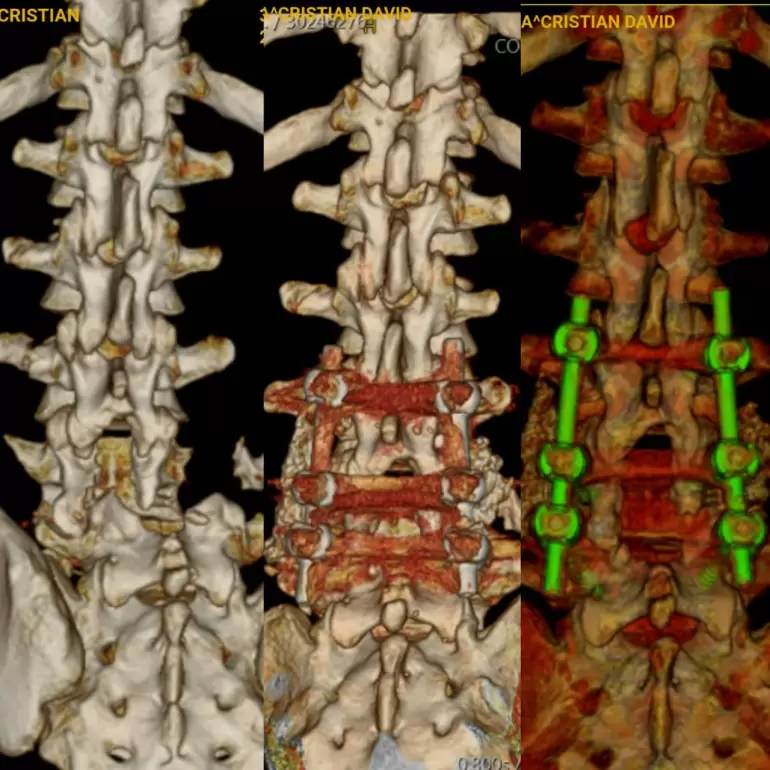 Exitosa ciruga de columna en el Instituto Mdico de la Comunidad