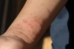 Cmo aliviar la picadura de chinches con solo 1 ingrediente de cocina