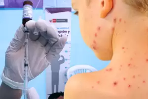 Aumentan los casos de sarampin, hepatitis A y tos convulsa: Porqu?