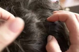 La planta medicinal que es ideal para eliminar piojos y liendres