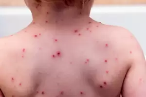 Alerta sarampin: Salud lanza recomendaciones para quienes viajan a AMBA