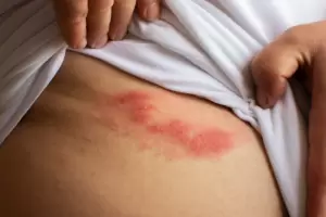 El avance silencioso del herpes zster: preocupa su impacto en adultos mayores