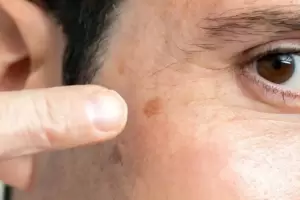 Piel perfecta: cmo identificar las manchas y que tratamientos realizar, segn los expertos