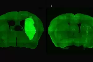 Especialistas del CONICET lograron frenar un tipo de cncer cerebral con una novedosa estrategia