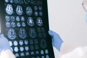 Estudio de Oxford revela que dos vacunas podran reducir el riesgo de Alzheimer