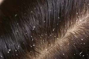 Paso a paso: cmo usar vinagre de manzana para combatir la caspa