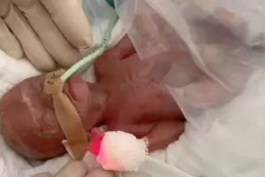 Beb de solo 16 semanas de gestacin sobrevivi: los mdicos hablan de "un verdadero milagro"