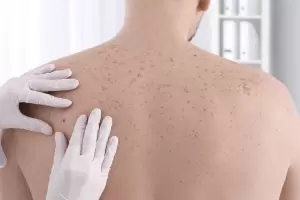 Cncer de piel: alertan sobre el aumento de lesiones cutneas en Catamarca