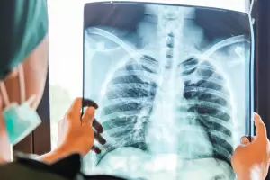 Advierten un fuerte aumento de casos de cncer de pulmn hacia 2050