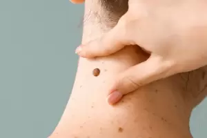 Cambian de lugar la Jornada de prevencin de Cncer de piel: dnde ser?