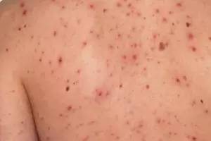 Chile emite alerta epidemiolgica por el brote de sarampin en Argentina y refuerza la vacunacin