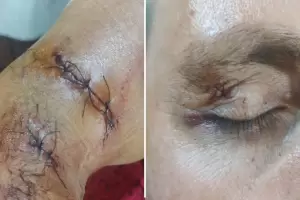 Catamarca: un hombre sufri� graves heridas tras ser atacado por un perro