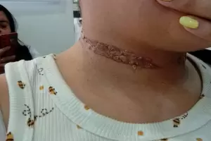 Catamarca: Una motociclista result� gravemente herida tras engancharse con un cable suelto